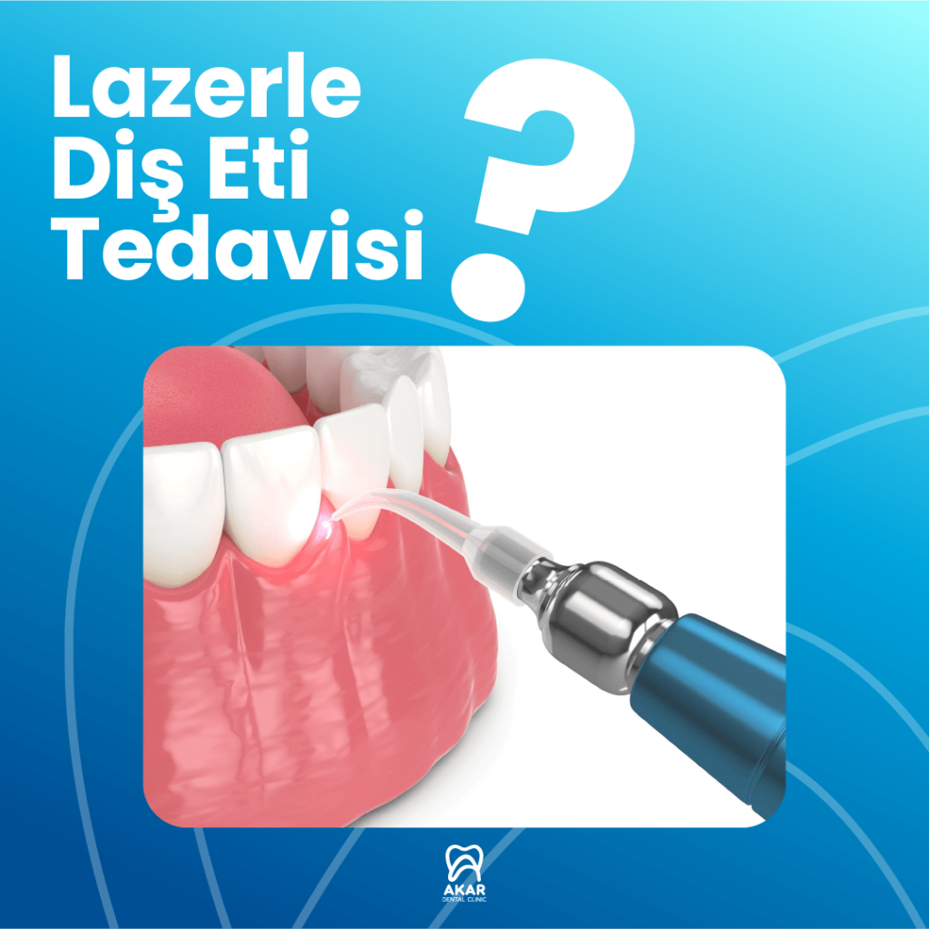 Lazerle Di Eti Tedavisi Antalya Akar Dental