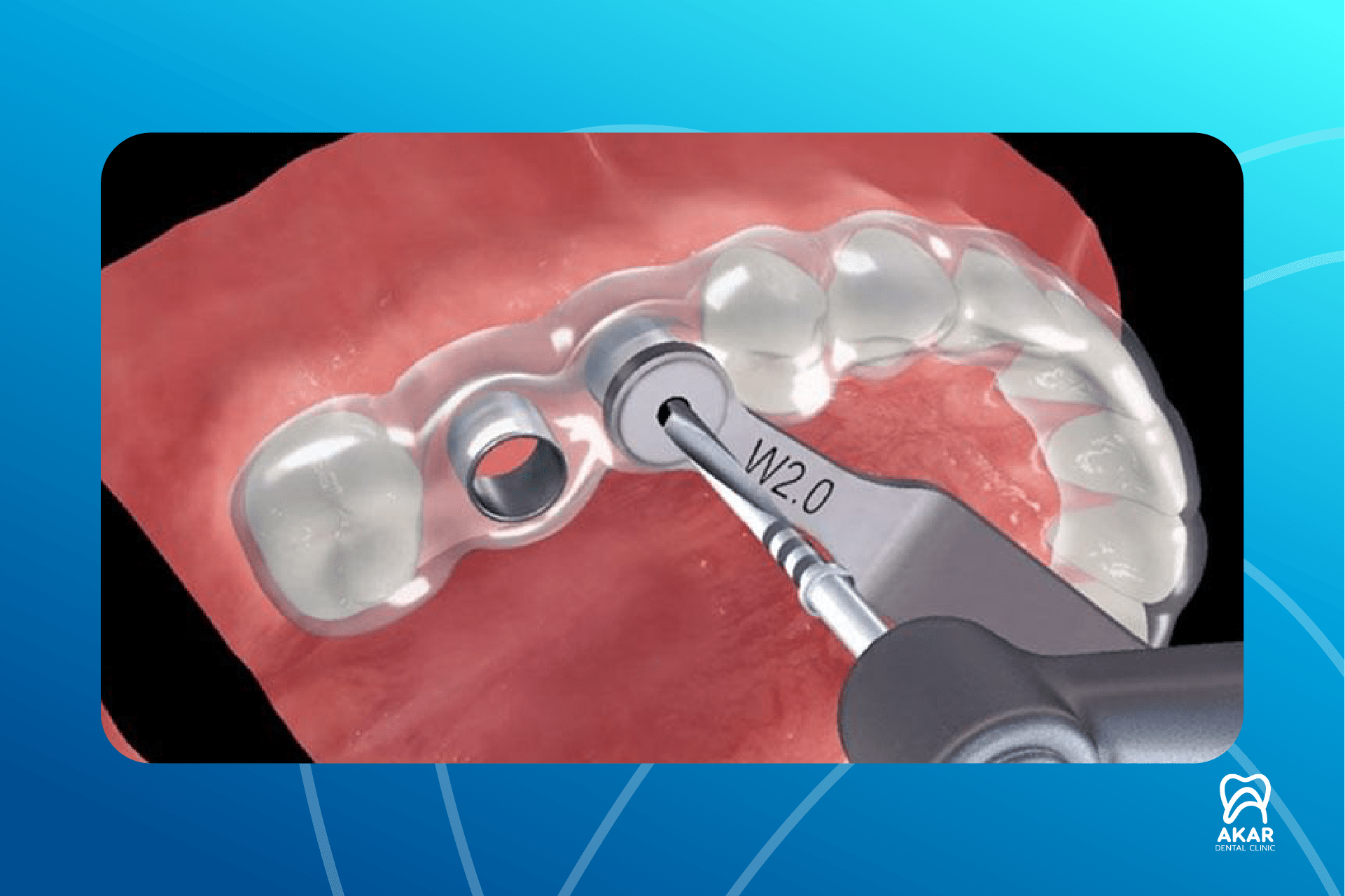 Non-Surgical Implant