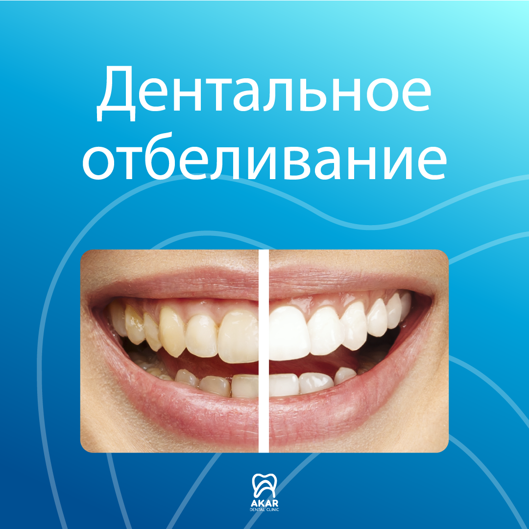 Отбеливание зубов в Анталии - Akar Dental