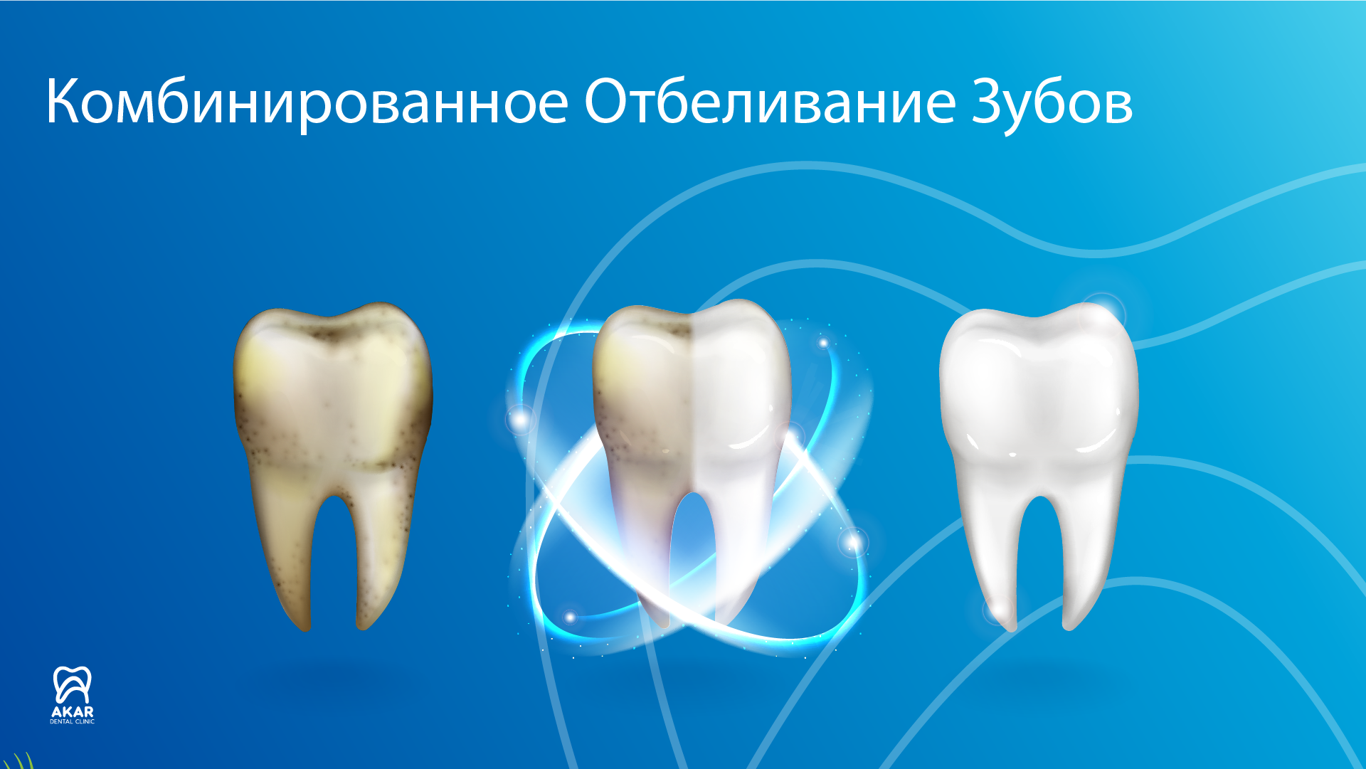 Отбеливание зубов в Анталии - Akar Dental