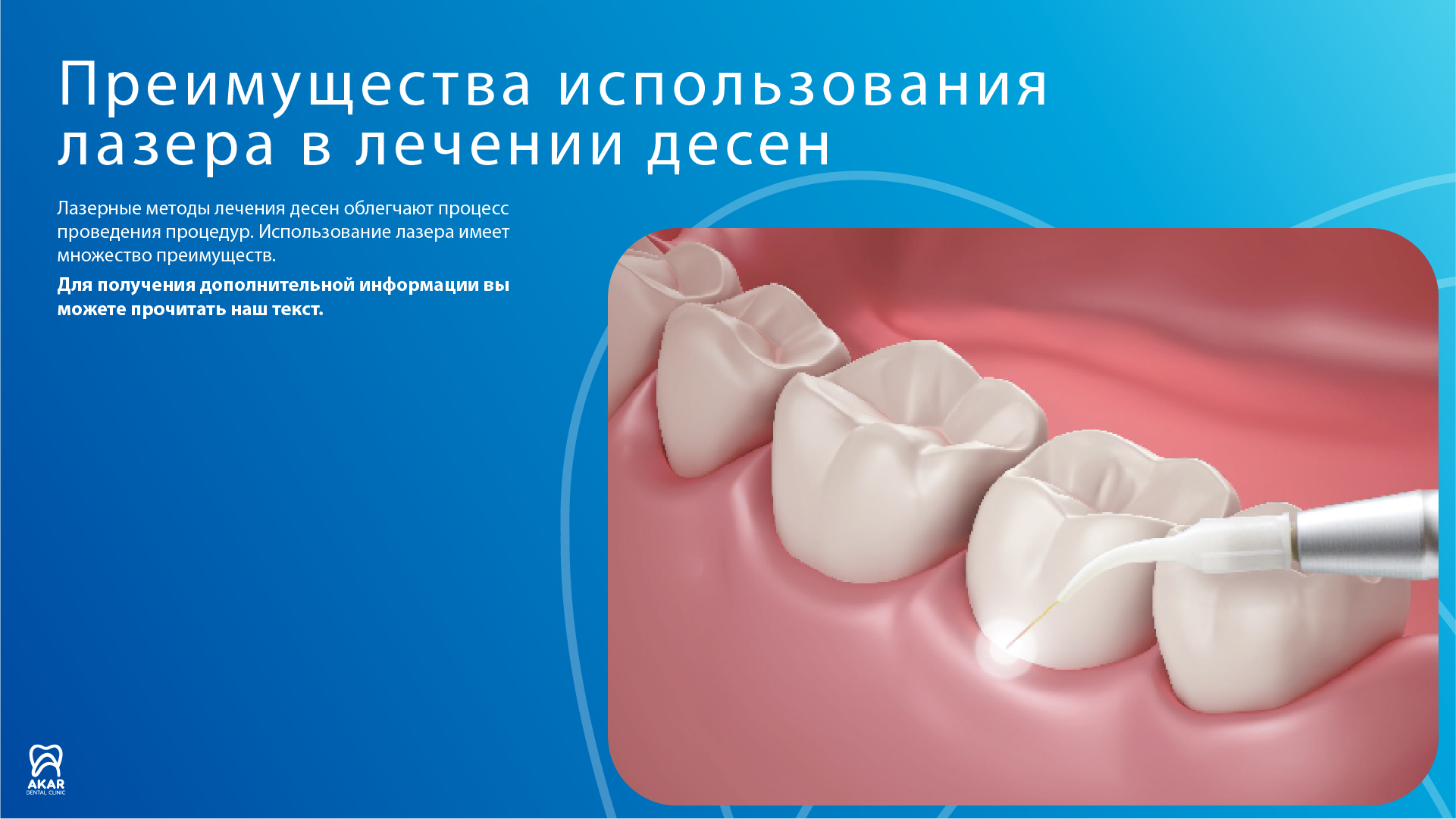 Лечение десен с помощью лазера - Akar Dental