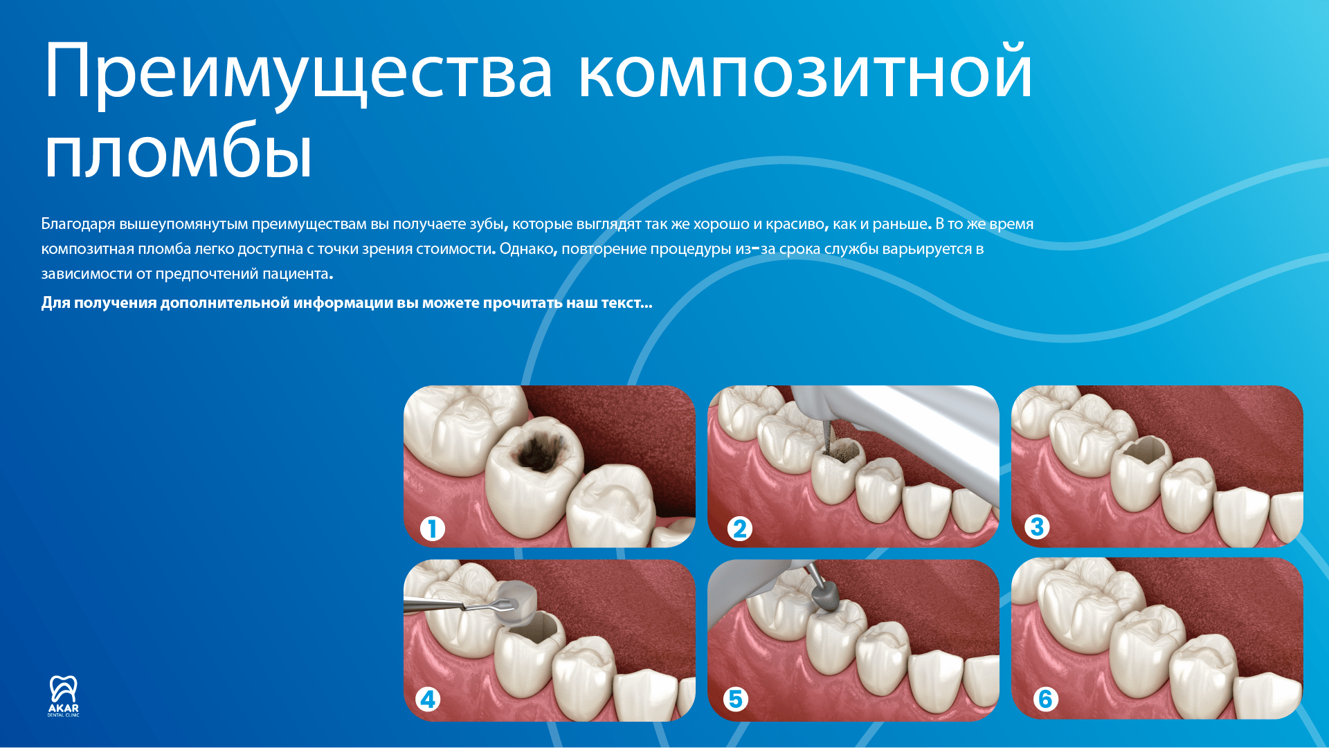 Композитная пломба - Akar Dental