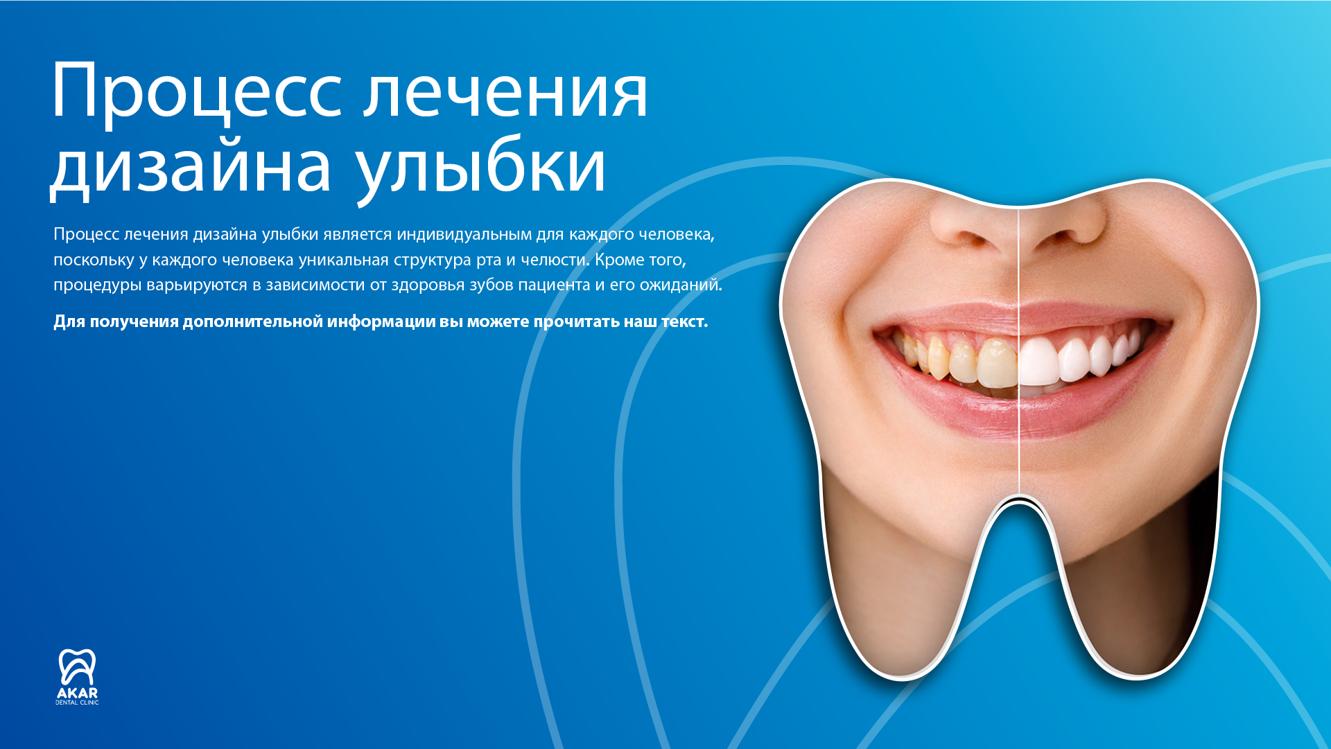 Дизайн улыбки в Анталии - Akar Dental