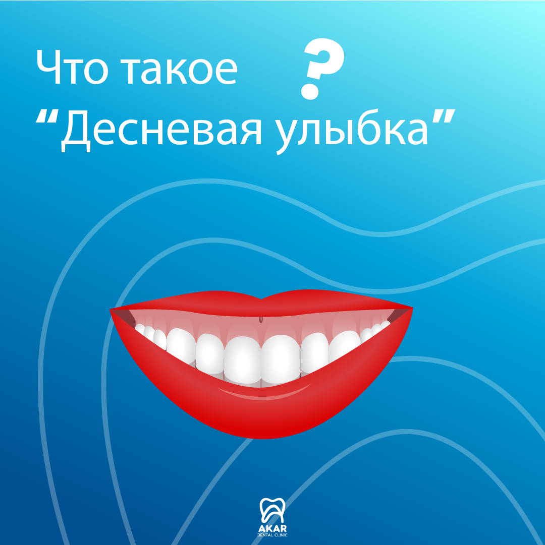 Десневая улыбка в Анталии - Akar Dental