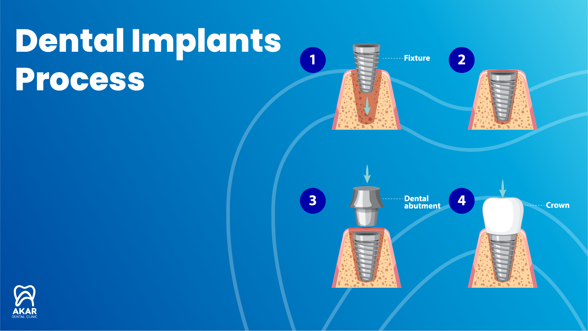 Dental Implants Process - Turkey - Antalya