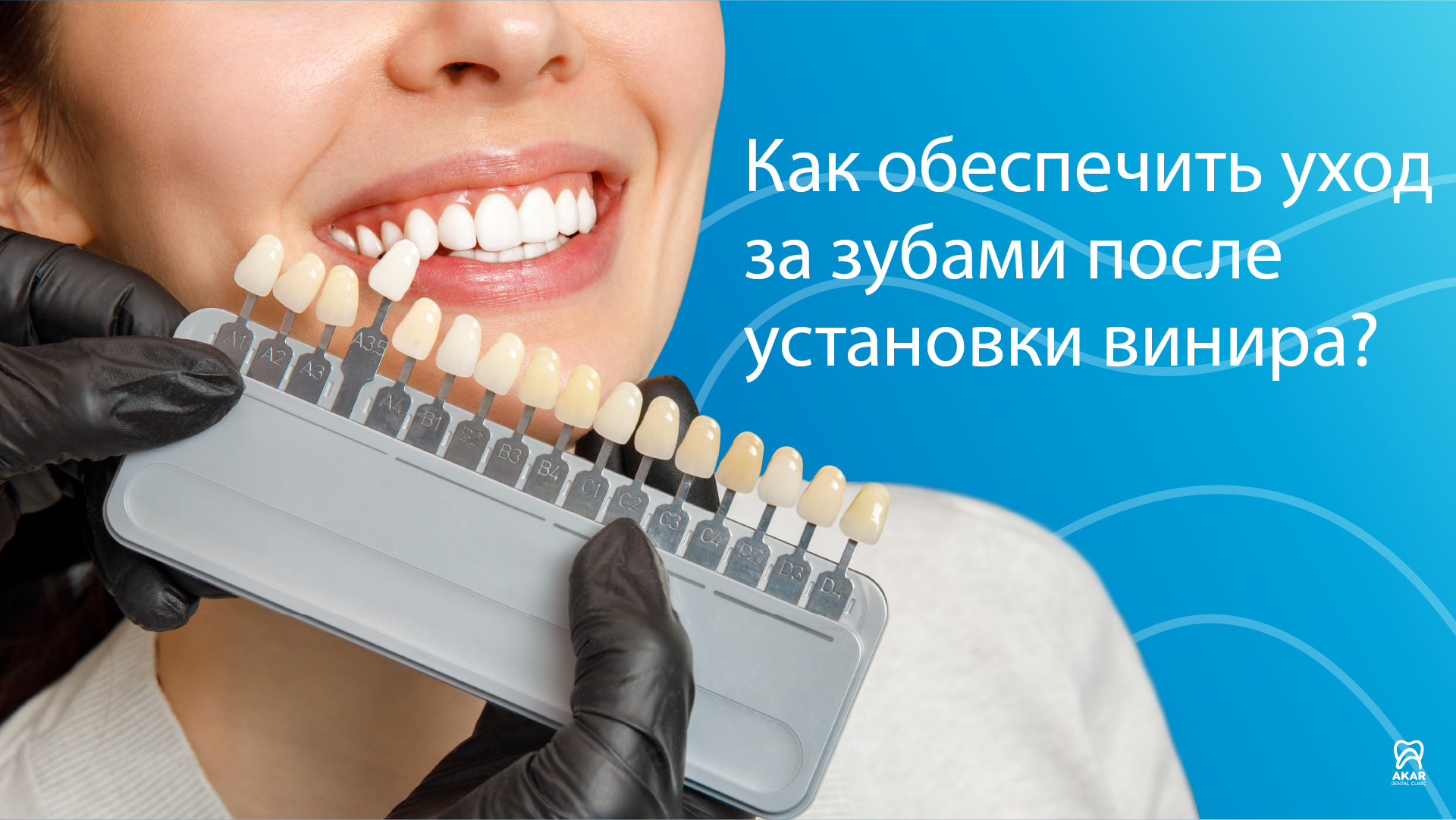 Как обеспечить уход за зубами после установки винира? - Анталия, Турция